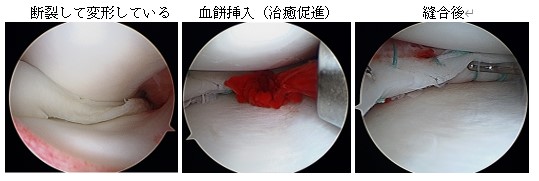 半月板損傷 スポーツ整形外科 牧整形外科病院 大阪市城東区 脊椎 人工関節 スポーツ整形 ペインクリニック 牧ヘルスケアグループ 医療法人 清翠会