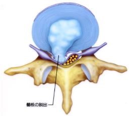 椎間板ヘルニア 脊椎外科 おおさかグローバル整形外科病院 大阪市城東区 脊椎 人工関節 スポーツ整形 ペインクリニック 牧ヘルスケアグループ 医療法人 清翠会