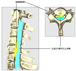 頚椎後縦靭帯骨化症 脊椎外科 牧整形外科病院 大阪市城東区 脊椎 人工関節 スポーツ整形 ペインクリニック 牧ヘルスケアグループ 医療法人 清翠会