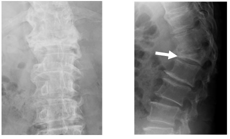 骨粗鬆症性脊椎圧迫骨折 脊椎外科 牧整形外科病院 大阪市城東区 脊椎 人工関節 スポーツ整形 ペインクリニック 牧ヘルスケアグループ 医療法人 清翠会