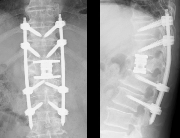 骨粗鬆症性脊椎圧迫骨折 脊椎外科 牧整形外科病院 大阪市城東区 脊椎 人工関節 スポーツ整形 ペインクリニック 牧ヘルスケアグループ 医療法人 清翠会