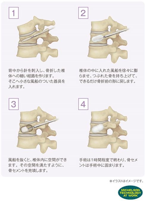 座り 圧迫 方 骨折