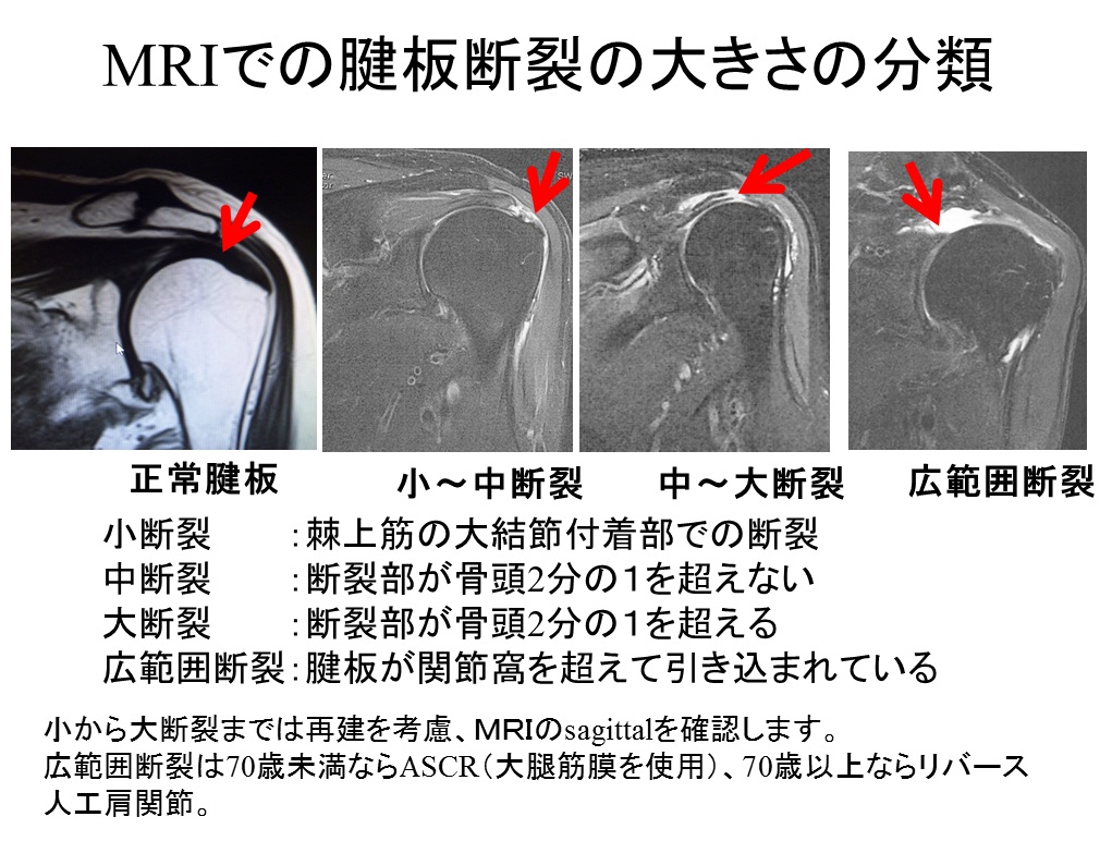 肩関節外科 | おおさかグローバル整形外科病院 | 大阪市城東区 | 脊椎 