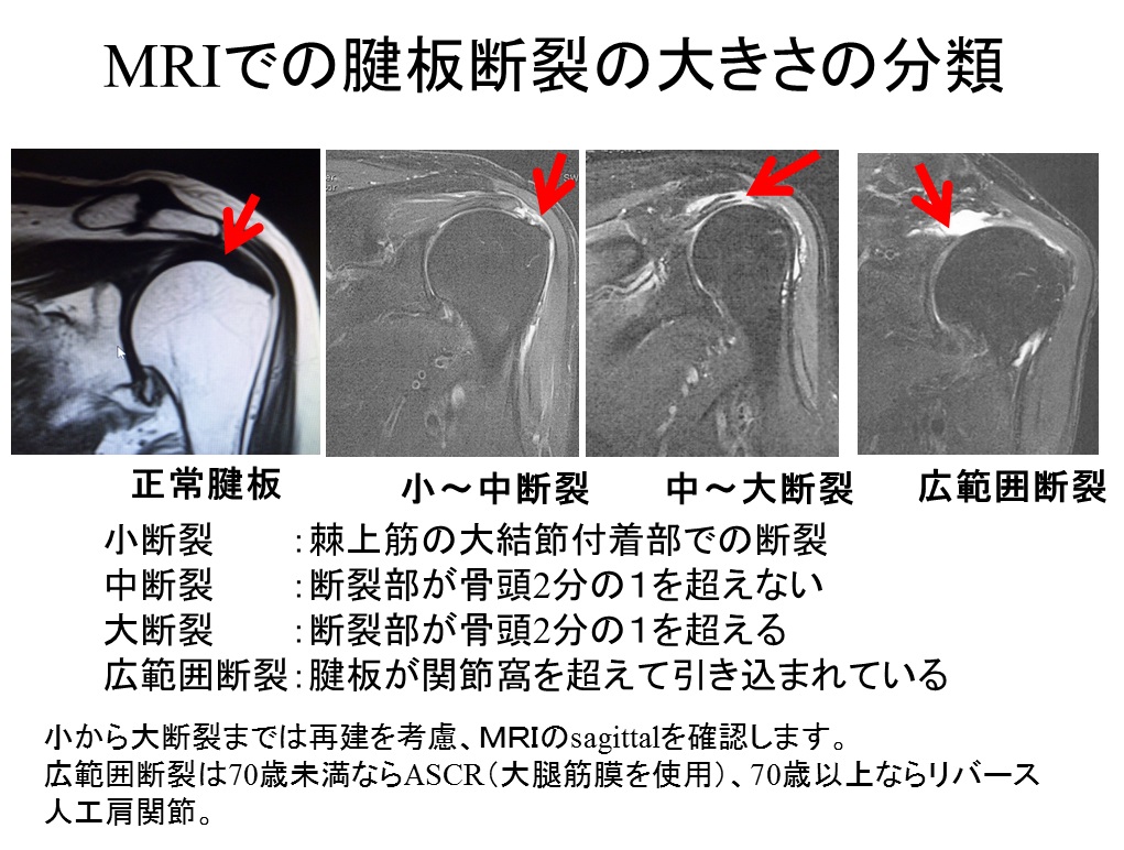 腱 板 断裂