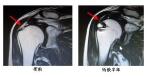 腱 板 断裂