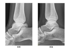 後方インピンジメント症候群 三角骨障害 スポーツ整形外科 おおさかグローバル整形外科病院 大阪市城東区 脊椎 人工関節 スポーツ整形 ペインクリニック 牧ヘルスケアグループ 医療法人 清翠会