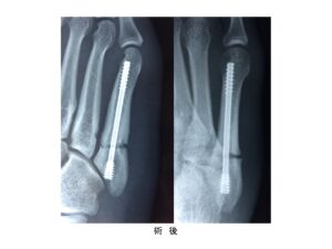 第5中足骨骨折 ジョーンズ骨折 スポーツ整形外科 おおさかグローバル整形外科病院 大阪市城東区 脊椎 人工関節 スポーツ整形 ペインクリニック 牧ヘルスケアグループ 医療法人 清翠会