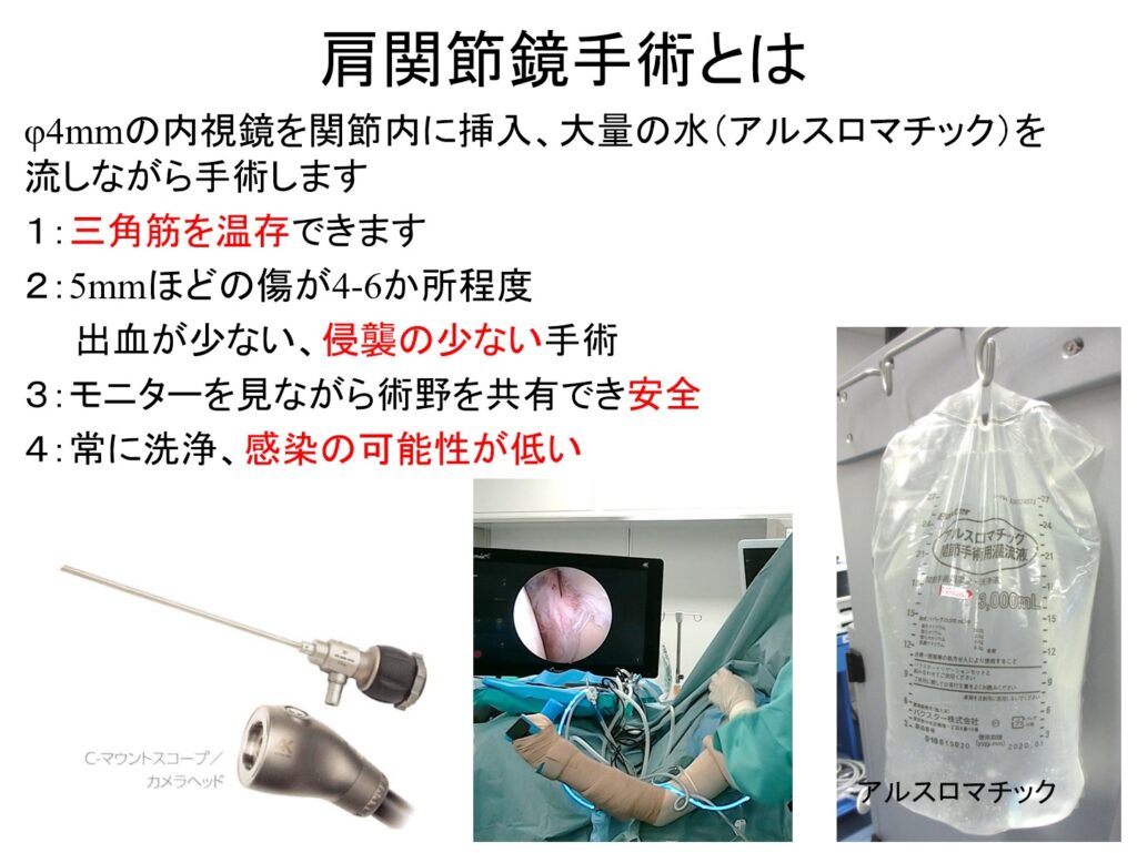 肩関節鏡の手術を受けられる患者様へ おおさかグローバル整形外科病院 大阪市城東区 脊椎、人工関節、スポーツ整形、ペインクリニック